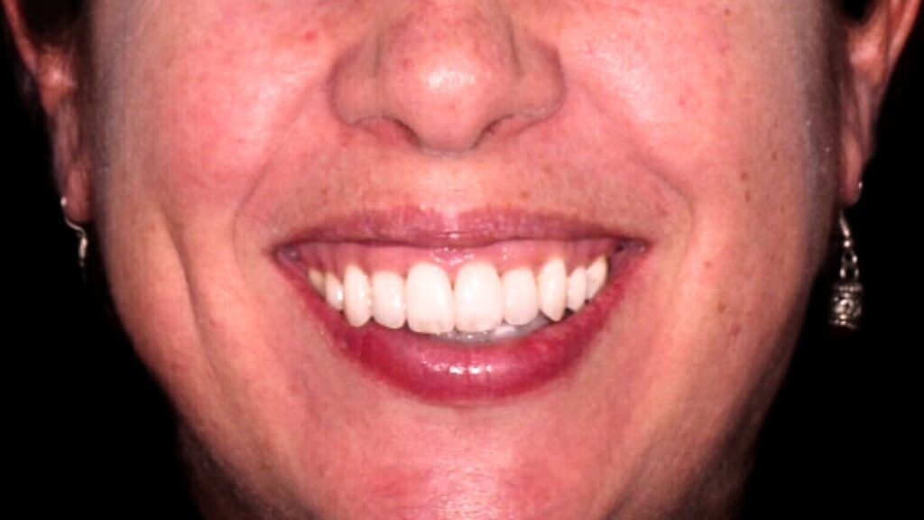 antes y despues periodoncia blanqueamiento