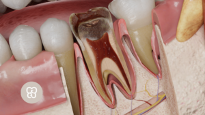 pulpitis dental