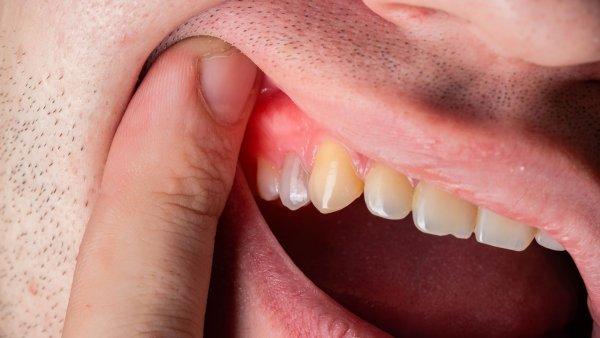Liquen plano oral
