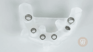 cirugía guiada en implantes dentales