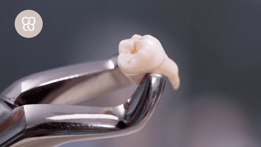 extracción de muelas en clínica dental en Madrid