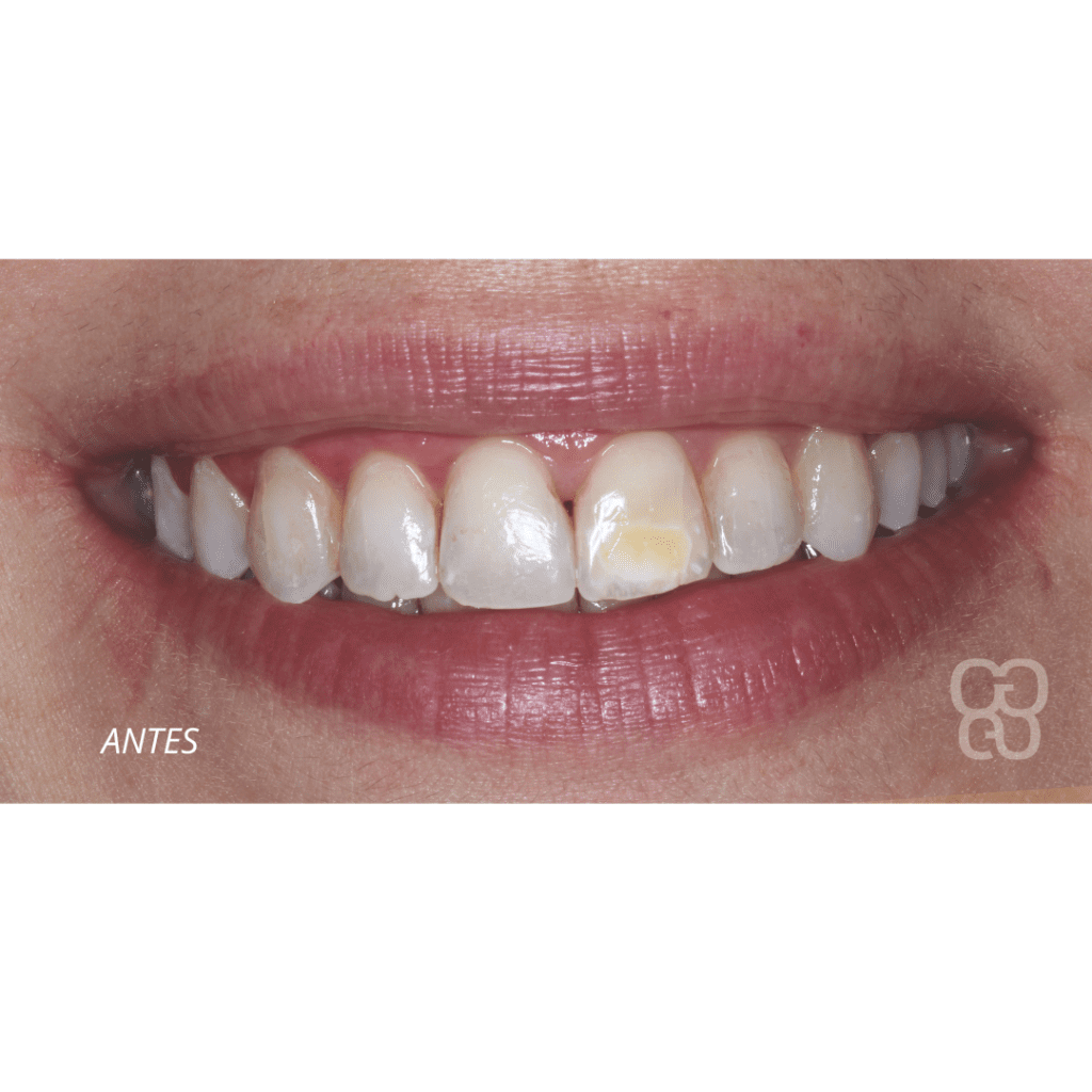 golpe en los dientes