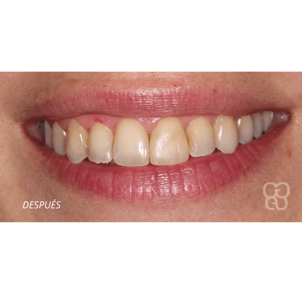 urgencias golpe dientes